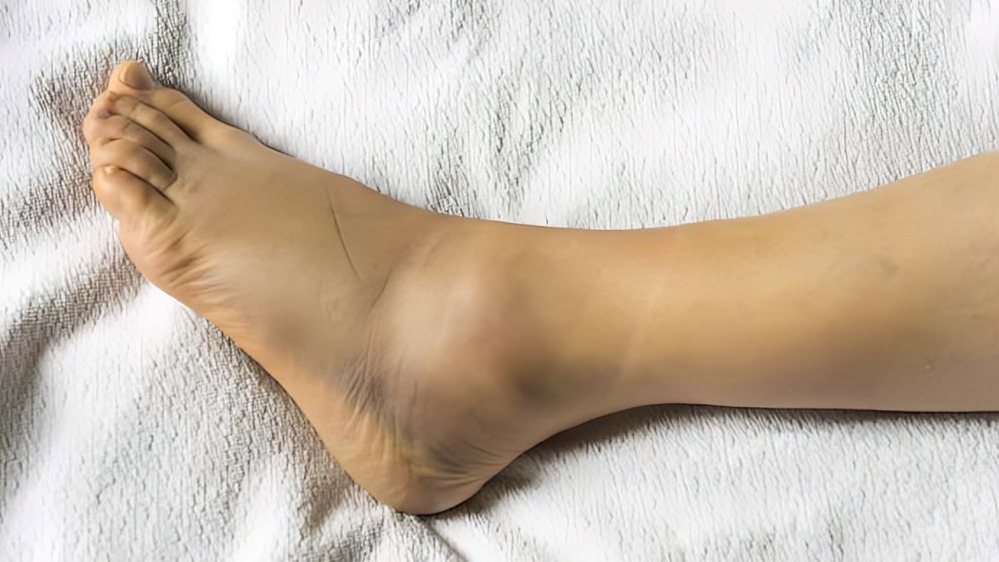 Muay Thai Injuries